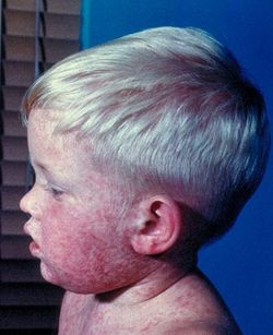 Мировая статистика отмечает снижение смертности от кори 