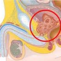 Лечение рака простаты с помощью ультразвука